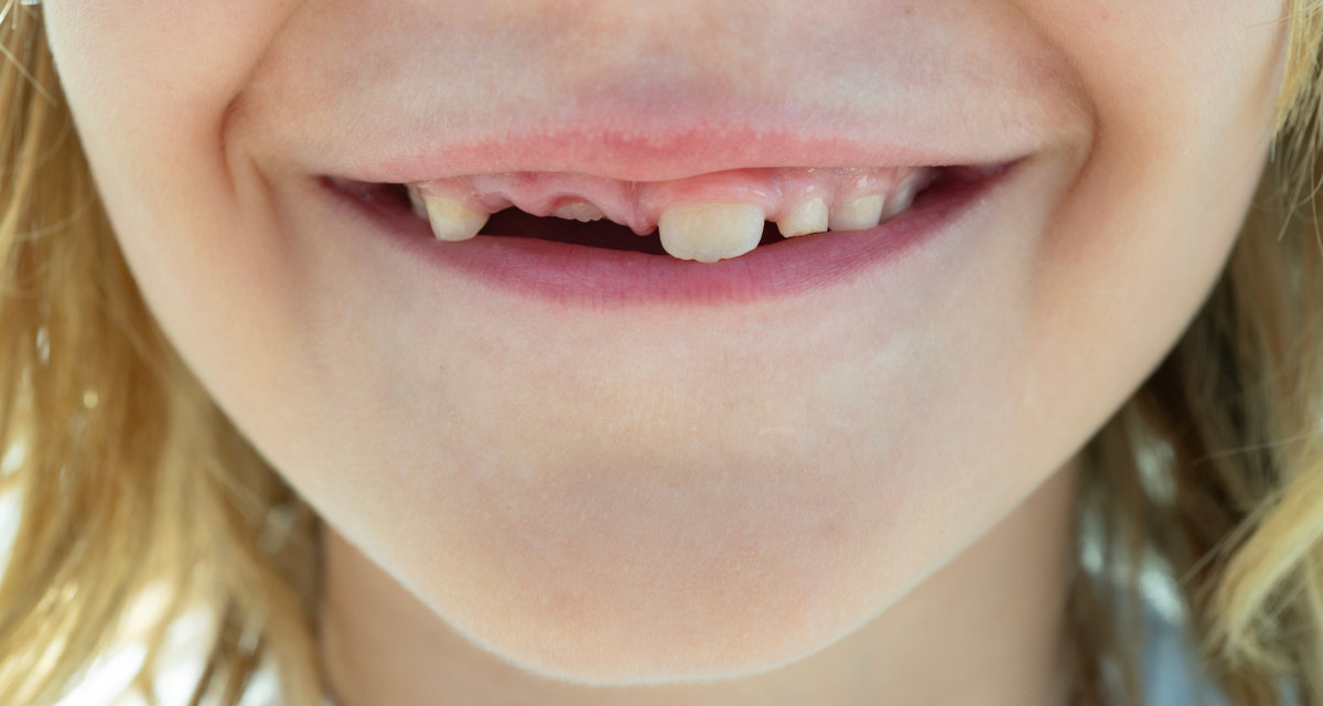Child with tooth gap. Closeup of child mouth with missing tooth. Kid showing new teeth growing. Toothless kids smile. Child losing teeth. Kid with missing tooth close-up mouth. Dental growth in child