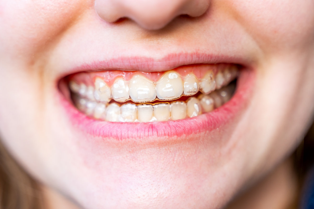 The girl has invisible braces on her teeth. Teeth straightening.