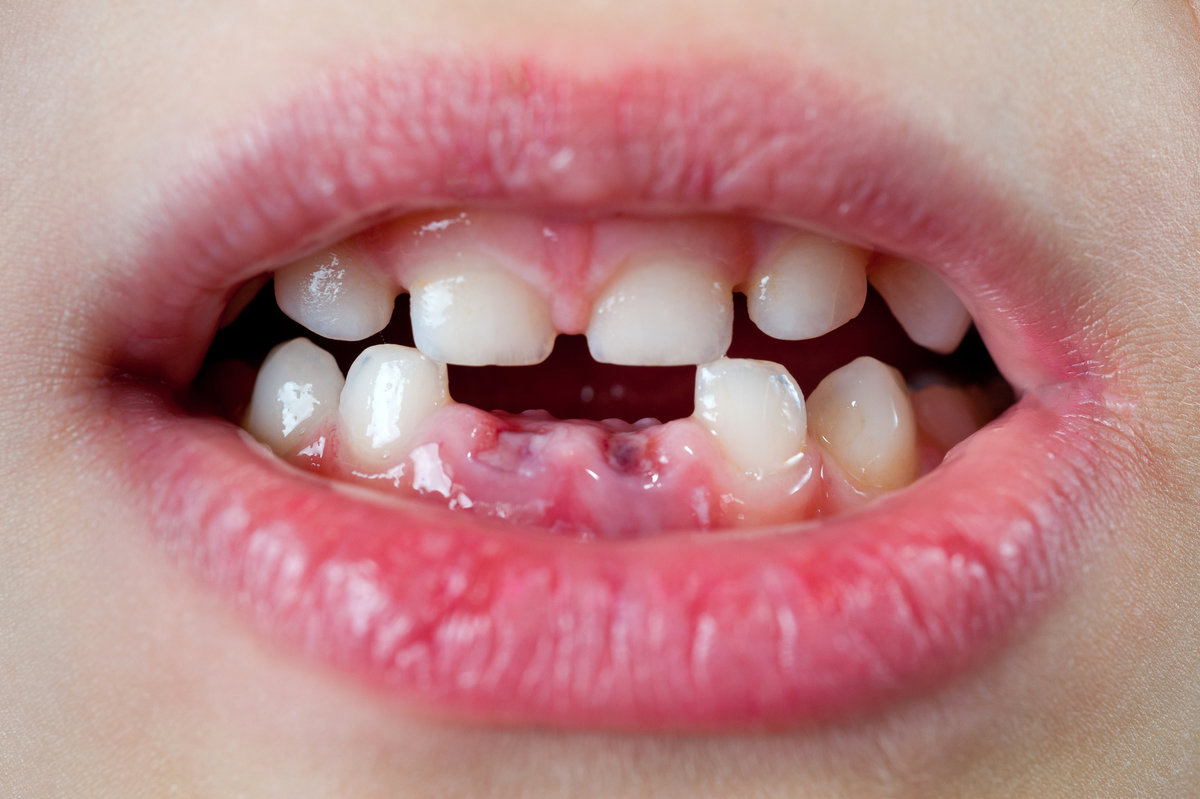 Child's mouth with two anterior lower milk teeth pulled out.